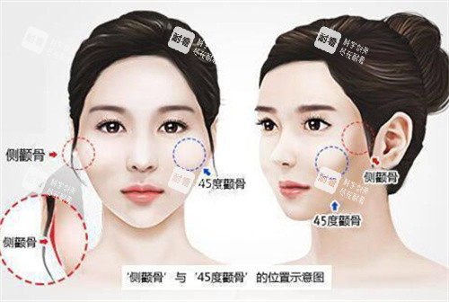 颧骨高突出演示动画图