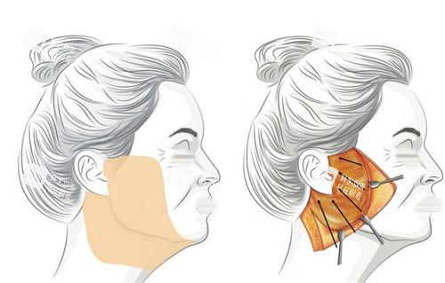 拉皮手术脂肪剥离示意图 拉皮手术脂肪剥离示意图