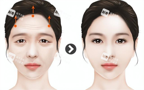 拉皮提眉手术演示动画图 拉皮提眉手术演示动画图