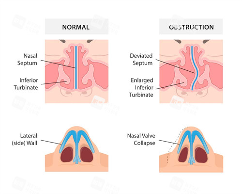 扭曲鼻子的修复对比图 扭曲鼻子的修复对比图