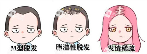 脱发种类 脱发种类