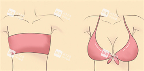大胸缩小