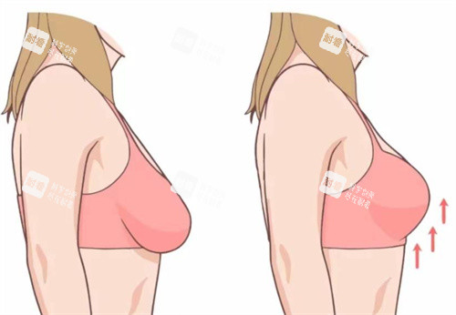 胸下垂前后对比图