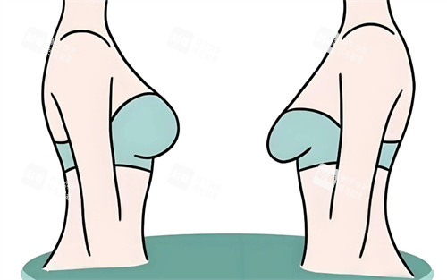 胸部下垂提升对比卡通图
