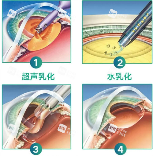 超声乳化白内障手术过程