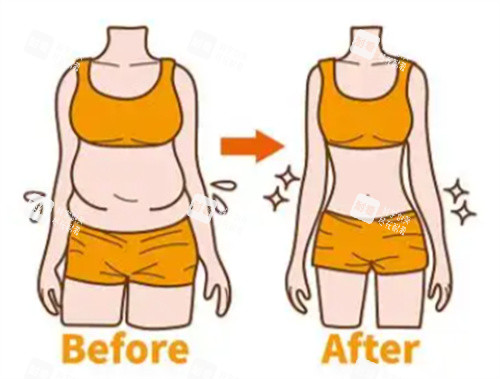 腰腹吸脂前后对比图