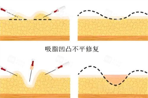 吸脂术后皮肤凹凸不平