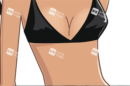 隆胸手术卡通宣传图