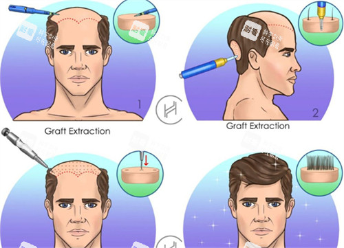 脂溢性脱发植发前后对比图