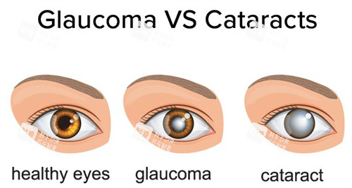 正常眼睛白内障和青光眼 正常眼睛白内障和青光眼