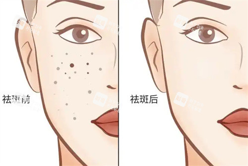 祛斑前后对比 祛斑前后对比