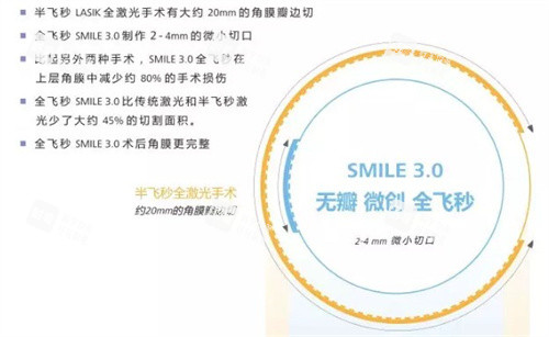 全飞秒手术3.0