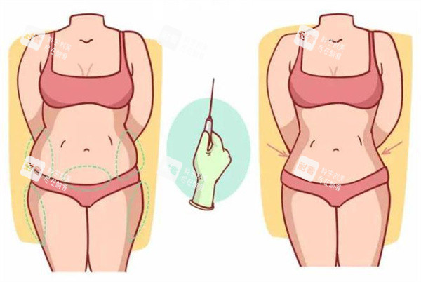 吸脂填充术 吸脂填充术