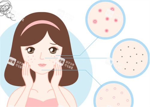 闭口问题皮肤状态