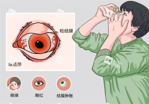 结膜炎卡通图