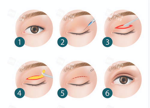 双眼皮手术过程图