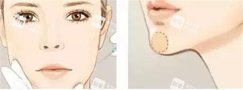 注射垫下巴的部位