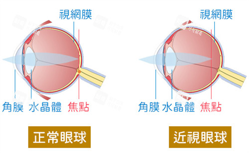 正常眼球和近视眼球的区别图解