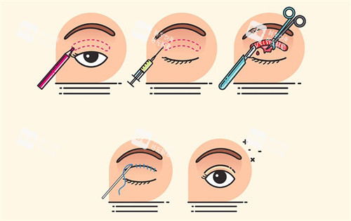 埋线双眼皮过程卡通图
