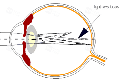 屈光不正散光示意图