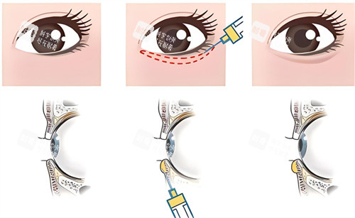 卧蚕填充原理 卧蚕填充原理