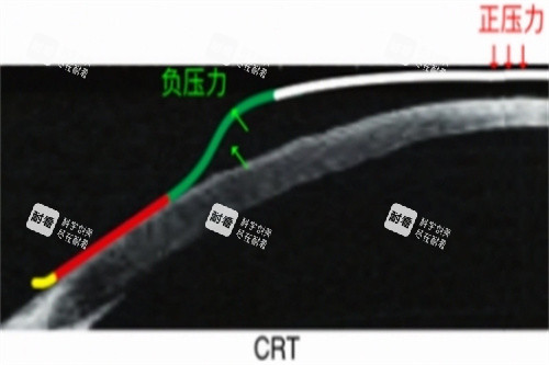 CRT角膜塑形镜力的示意图 CRT角膜塑形镜力的示意图