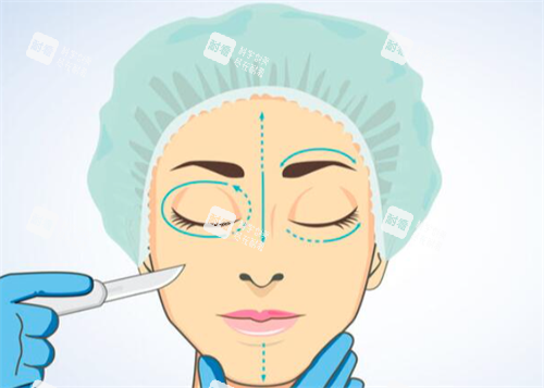双眼皮手术方案设计 双眼皮手术方案设计