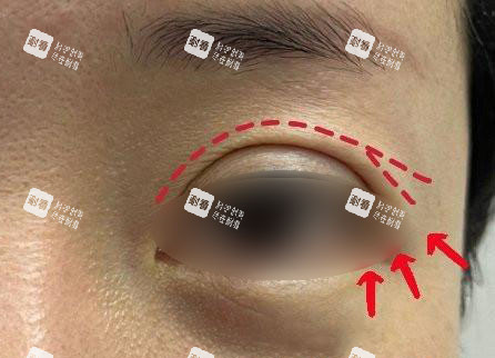 双眼皮眼尾开叉 双眼皮眼尾开叉