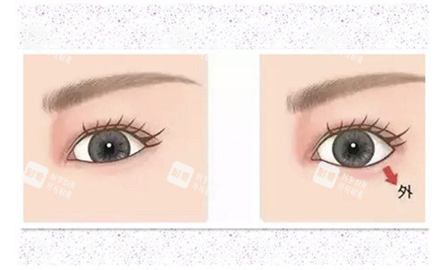 眼型矫正手术 眼型矫正手术