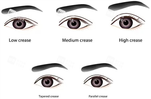 不同类型的双眼皮 不同类型的双眼皮