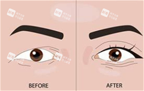 双眼皮手术前后对比 双眼皮手术前后对比