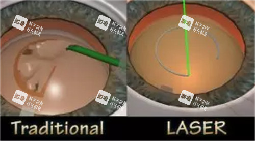 全飞秒手术操作过程图解 全飞秒手术操作过程图解