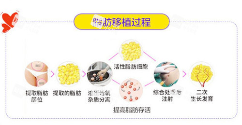 脂肪移植过程 脂肪移植过程
