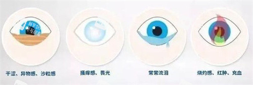近视手术后干眼症的症状2 近视手术后干眼症的症状2