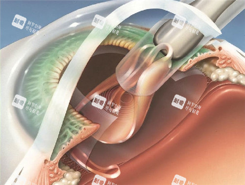 白内障手术细节图 白内障手术细节图