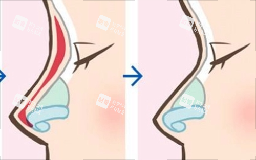 假体取出步骤动画展示