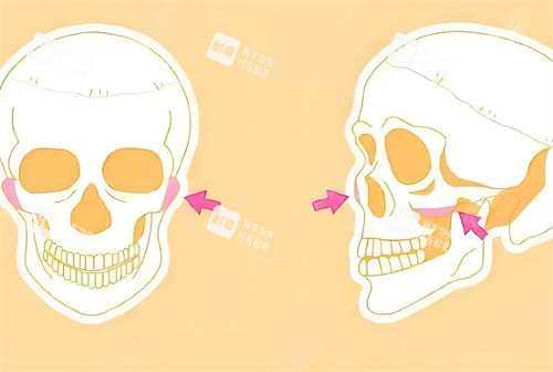 颧骨手术磨骨部位骨头演示动画图