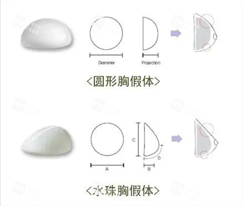 丰胸手术曼托圆形及水滴形假体植入示意图 丰胸手术曼托圆形及水滴形假体植入示意图