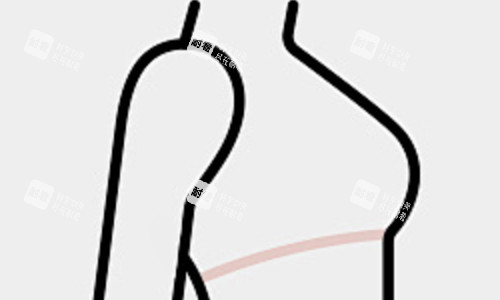 隆胸后展示 隆胸后展示