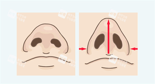 鼻翼缩后鼻子挺拔