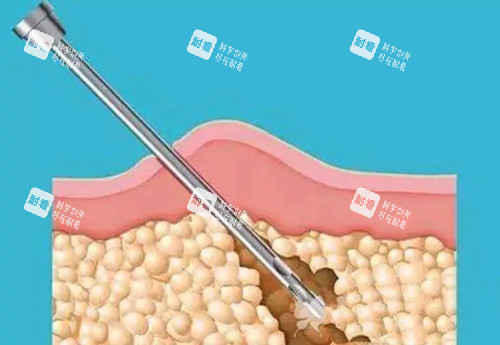 负压吸脂卡通示意图 负压吸脂卡通示意图