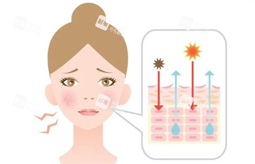 皮肤红血丝卡通