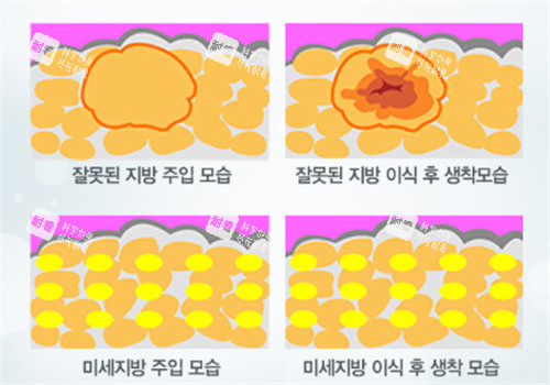 自体脂肪填充术后脂肪细胞前后对比