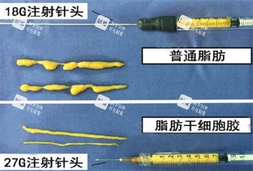 自体脂肪填充需要的脂肪提纯后的样子图片