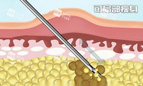 吸脂内部卡通图