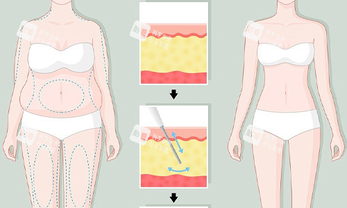 全身吸脂展示图