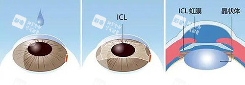 晶体植入改善展示图 晶体植入改善展示图