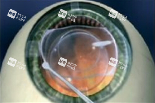 ICL晶体展开 ICL晶体展开