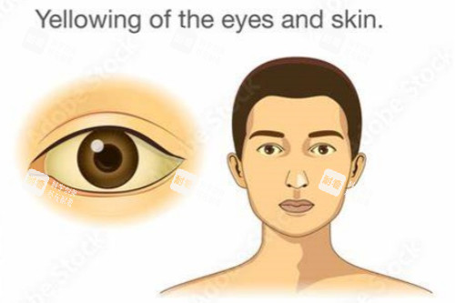 眼睛发黄 眼睛发黄