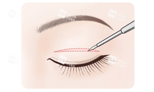 北京安贞医院整形科双眼皮怎么样？李斌斌林煌杨媚口碑医生测评，附擅长术式推荐